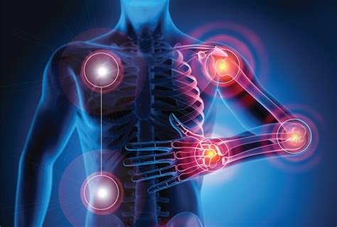 Artritis Reumatoide Enfermedad Sin Cura Pero Que Puede Tratarse Z