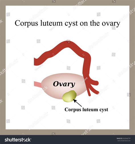 Corpus Luteum Cyst On Ovary Functional Stock Vector Royalty Free