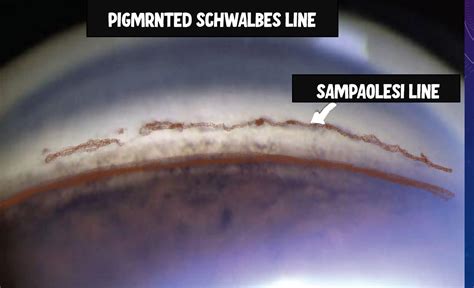 Anatomy Of Angle And Anterior Chamber Of Eye Insight Ophthalmology