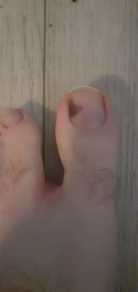 Black spot appeared on toenail roughly two months ago. I don't think