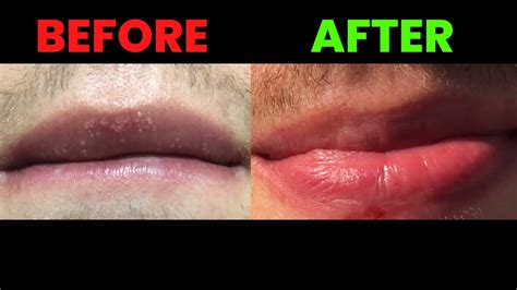 Fordyce Spots On Lips Removal New Update It Works 🙏🙏🙏 Youtube