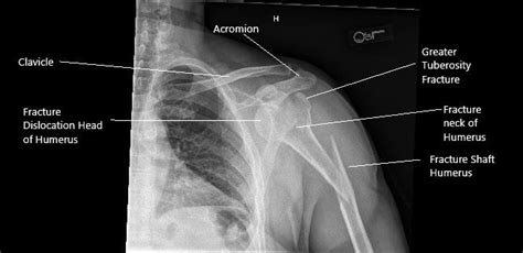 Case Study Fracture Dislocation Management Of The Joint