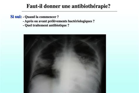 PPT Antibiothérapie probabiliste Le challenge des premières heures du