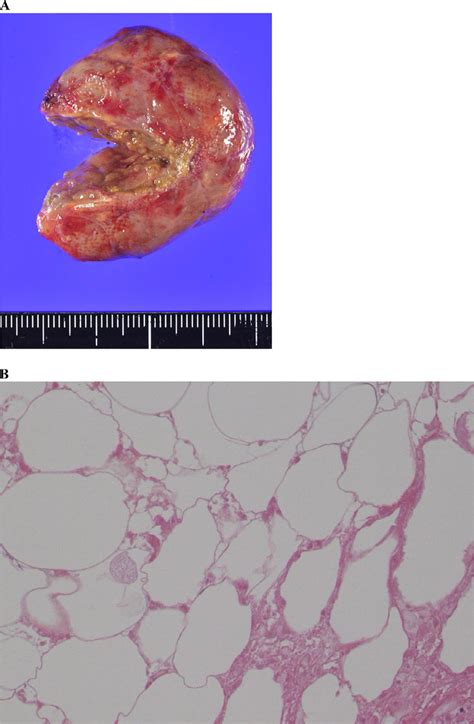 A Macroscopic Pathological Finding Tumor With The Degenerated Fatty