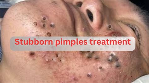 Hard Pimples Treatment Youtube