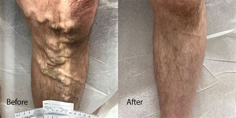 Before After Photos L Advanced Varicose Vein Treatments Of Manhattan NYC