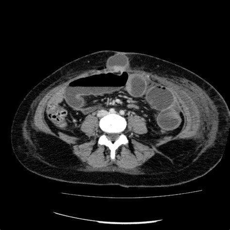 Small Bowel Obstruction Secondary To Entrapment In Laparoscopic Port