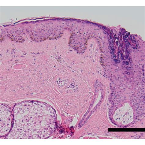 The Cross Section Of The Dermoepidermal Junction Of The Eyelid Margin