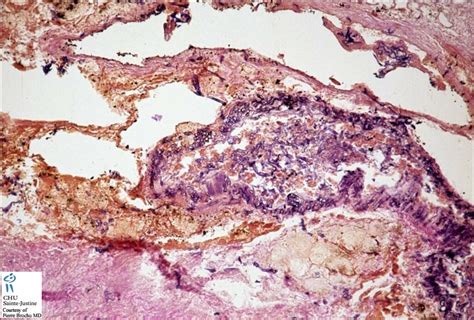 Zygomycoses Human Pathology
