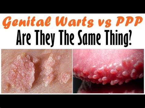 Vestibular Papillomatosis Vs Warts Vestibular Papillomatosis Vs Warts