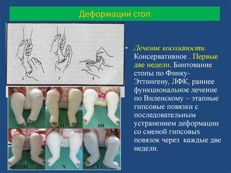 Деформация стопы - презентация онлайн