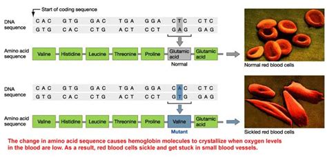 Gene Mutation In Sickle Cell Anaemia And Chromosome Mutation In Downs