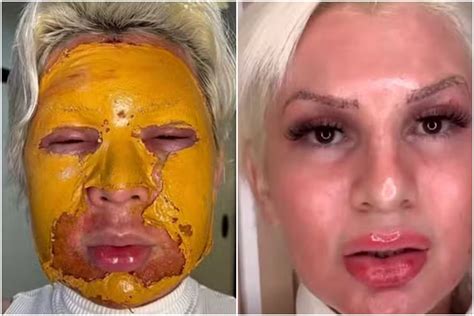 Peeling de fenol influencer é detonada na web após divulgar clínica