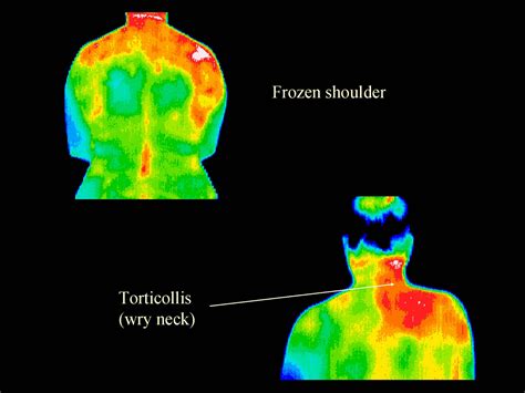 What is thermography? — Alternative Naturopathic Center