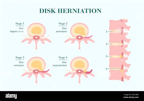 Lumbar Disc Herniation Hi Res Stock Photography And Images Alamy