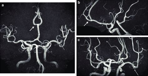 A MRA Shows An Aneurysm Of The MCA At The Left Bifurcation Long