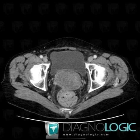 Cas Radiologie M Tastase Scanner Irm Diagnologic