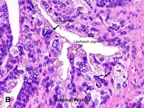 American Urological Association - Seminal Vesicles