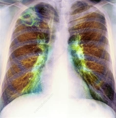 Drug use lung damage, X-ray - Stock Image - C007/2671 - Science Photo ...