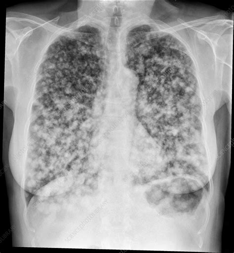 Secondary Lung Cancers X Ray Stock Image C0386647 Science Photo Library