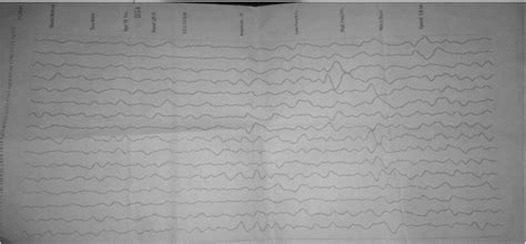 Electroencephalography Eeg Study Showed Severe Generalized Slowing