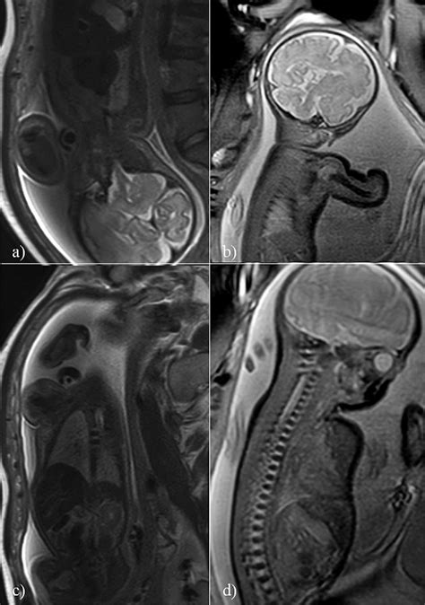 Fetal Mri A Btfe Spir Cor T2 Weighted Sequence In A Fetus With