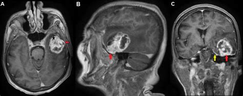 Axial A Sagittal B And Coronal C T1 Weighted Mri Scans With