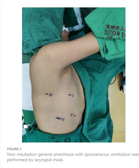 Figure 1 From Minimally Invasive Esophagectomy With Non Invasive Ventilation By Laryngeal Mask