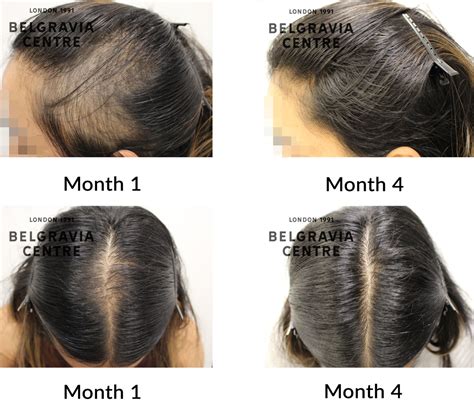 Hair Loss Success Story The Trichologist I First Interacted With Made