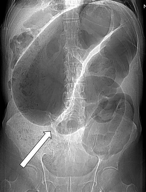 Pearls And Pitfalls In Multimodality Imaging Of Colonic Volvulus