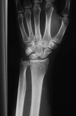 orthobullets  radiographs  reveal  gap