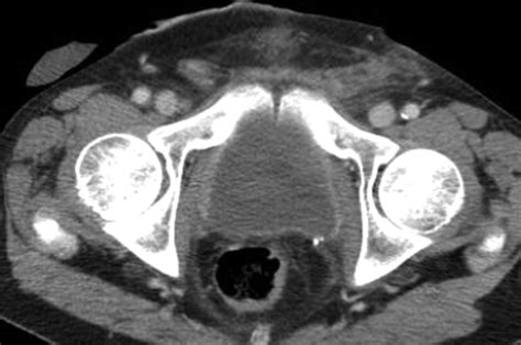 CT Findings In Urinary Diversion After Radical Cystectomy Postsurgical