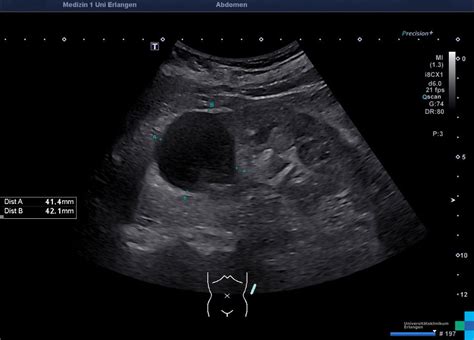 Einfache Nierenzyste Sonographieatlas Erlangen