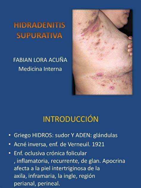 Pdf Hidradenitis Supurativa Compress Pdf