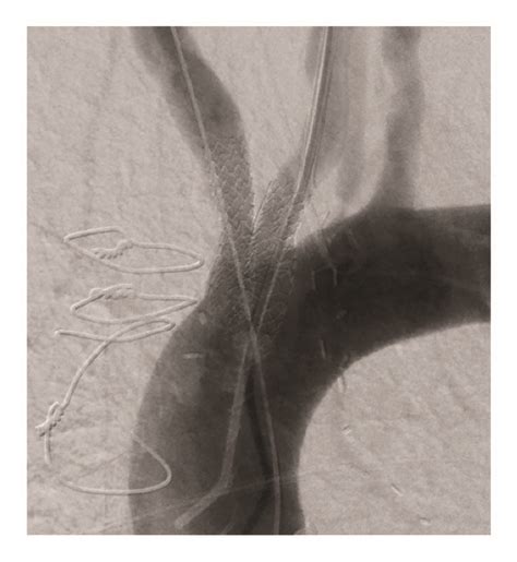 A Baseline Angiogram Of Severe Stenosis Of The Innominate And Left