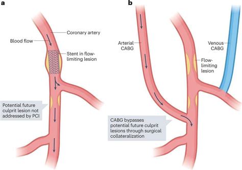 Consensus recommendations for imaging of coronary artery stenosis and ...