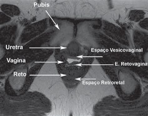 Anatomia dos espaços pélvicos Ressonância magnética da pelve axial