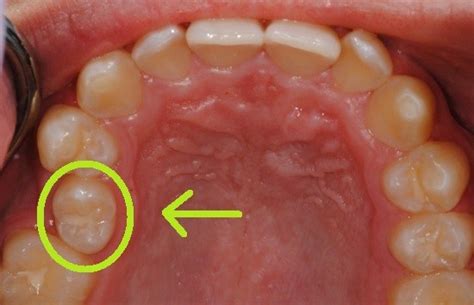 Viagem Pela Ortodontia Oclus O Normal Na Denti O Permanente