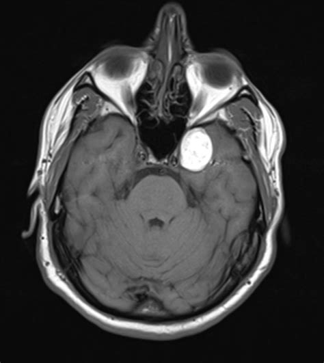 Ruptured Parasellar Dermoid Cyst Image