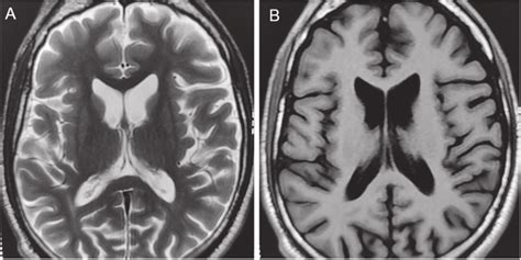 Early Caudate Atrophy On A Axial MRI T2 Weighted Image And B On