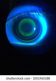 Orthokeratology Contact Lens Fitting Stock Photo 1051965188 | Shutterstock