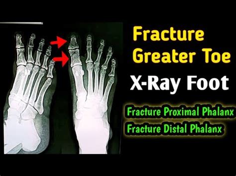 Fracture Greater Toe Fracture Proximal Phalanx Distal Phalanx X