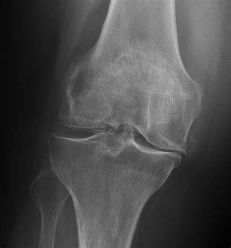 Chronic Knee Pain — Nuem Blog