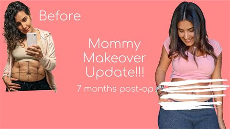 Mommy Makeover Surgery Surgery Journey Seven Months Recovery