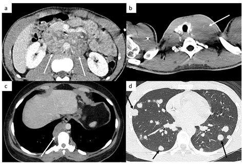 Cancers Free Full Text The Role Of Ct In The Staging And Follow Up