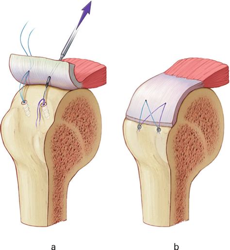 Biomechanical Evaluation Of A Novel Double Rip Stop Technique With