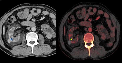 From Left To Right Contrast Enhanced Portal Venous And Iodine Overlay Download Scientific