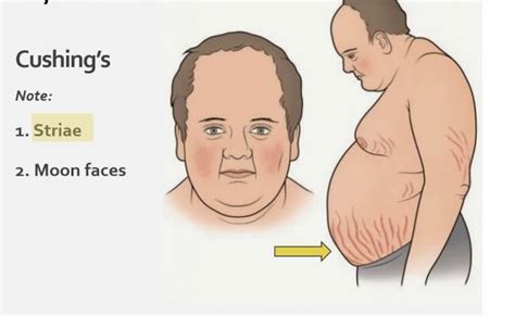 Cushing S Syndrome Rash