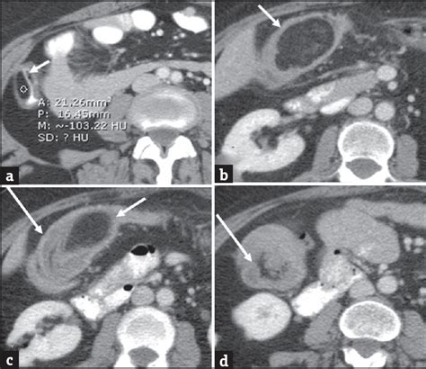 Large Bowel Obstruction In The Emergency Department Imaging Spectrum