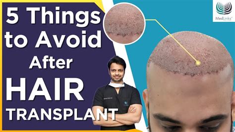 5 Things To Avoid After Hair Transplant In Hindi 🤷‍♂️dos And Dont